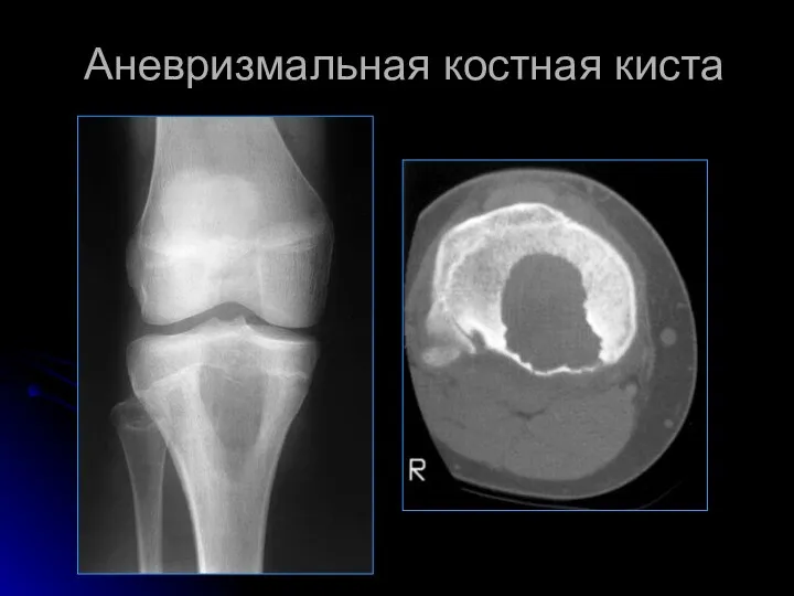 Аневризмальная костная киста