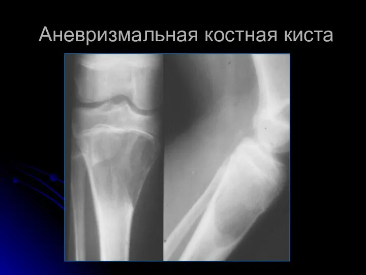 Аневризмальная костная киста