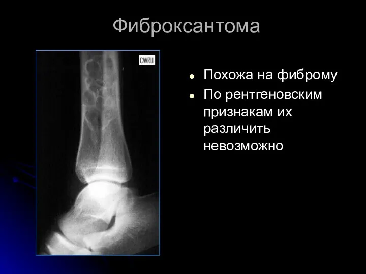 Фиброксантома Похожа на фиброму По рентгеновским признакам их различить невозможно