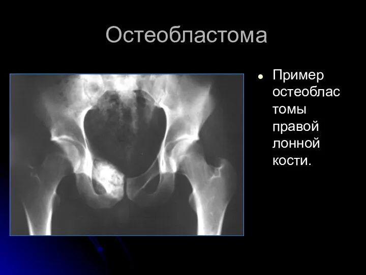 Остеобластома Пример остеобластомы правой лонной кости.