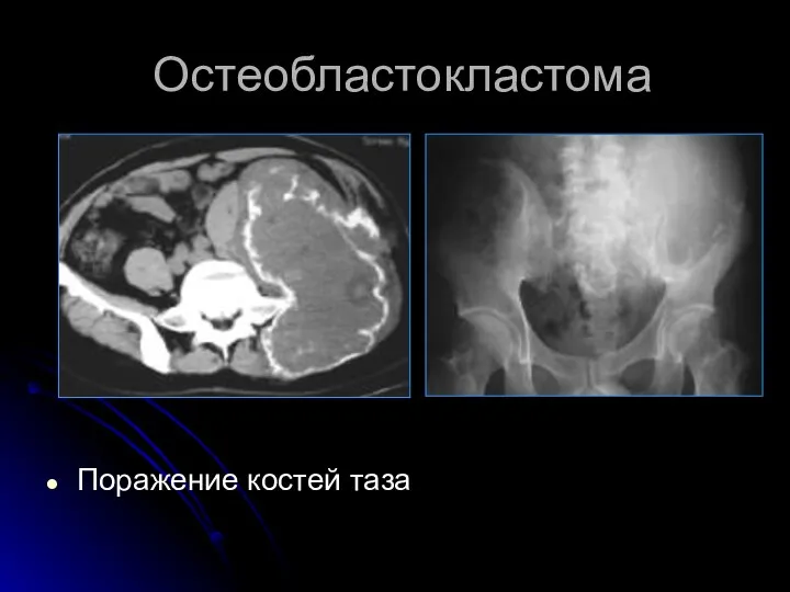 Остеобластокластома Поражение костей таза