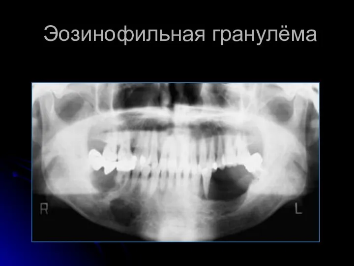 Эозинофильная гранулёма