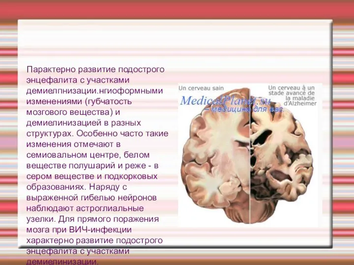 Парактерно развитие подострого энцефалита с участками демиелпнизации.нгиоформными изменениями (губчатость мозгового вещества)