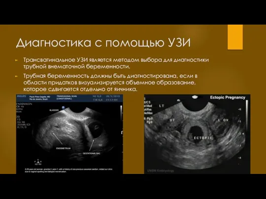 Диагностика с помощью УЗИ Трансвагинальное УЗИ является методом выбора для диагностики