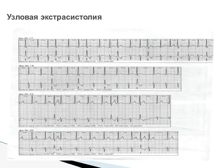 Узловая экстрасистолия