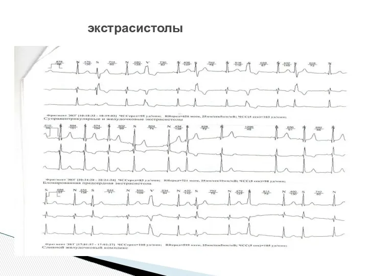 экстрасистолы