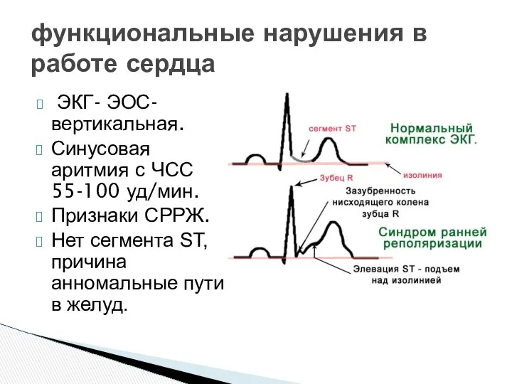 функциональные нарушения в работе сердца ЭКГ- ЭОС- вертикальная. Синусовая аритмия с