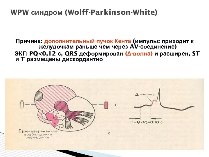 WPW синдром (Wolff-Parkinson-White) Причина: дополнительный пучок Кента (импульс приходит к желудочкам