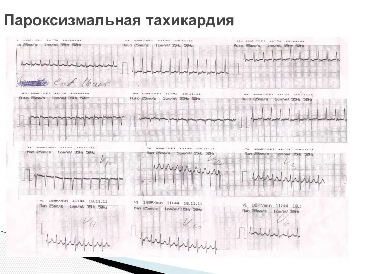 Пароксизмальная тахикардия