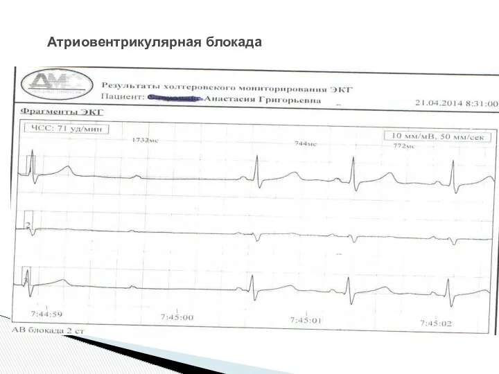 Атриовентрикулярная блокада