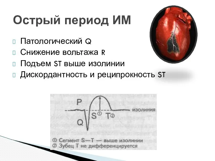 Острый период ИМ Патологический Q Снижение вольтажа R Подъем ST выше изолинии Дискордантность и реципрокность ST