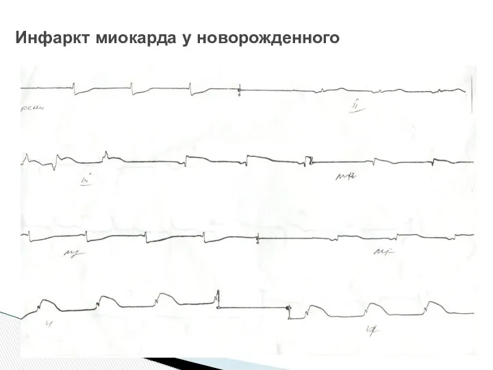 Инфаркт миокарда у новорожденного