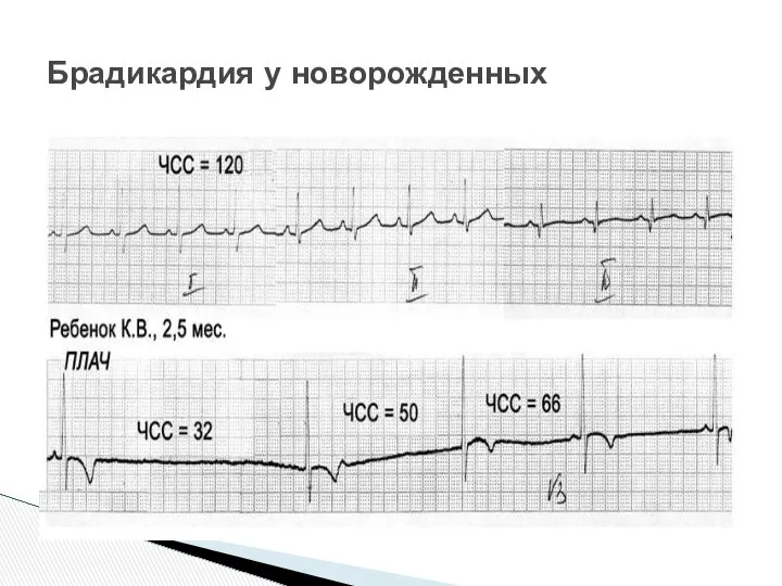 Брадикардия у новорожденных