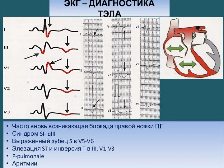 ЭКГ – ДИАГНОСТИКА ТЭЛА Часто вновь возникающая блокада правой ножки ПГ