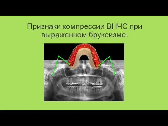 Признаки компрессии ВНЧС при выраженном бруксизме.