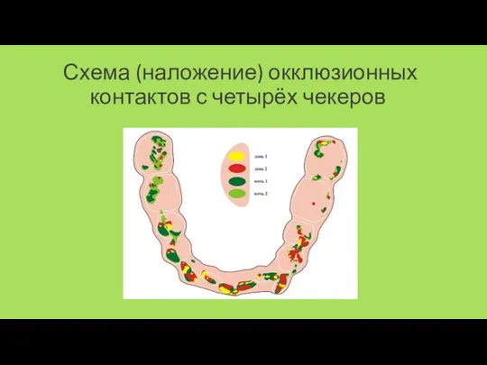 Схема (наложение) окклюзионных контактов с четырёх чекеров