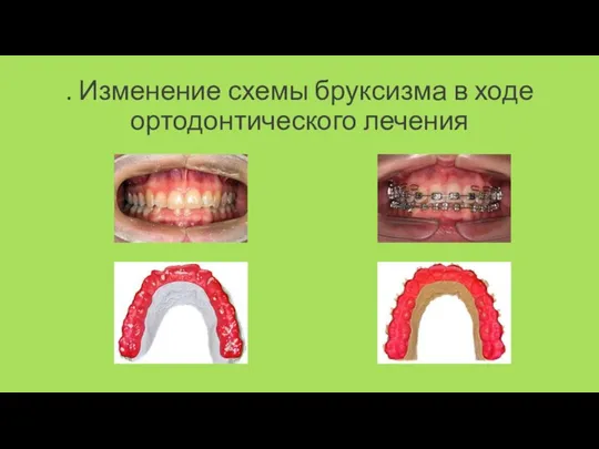 . Изменение схемы бруксизма в ходе ортодонтического лечения