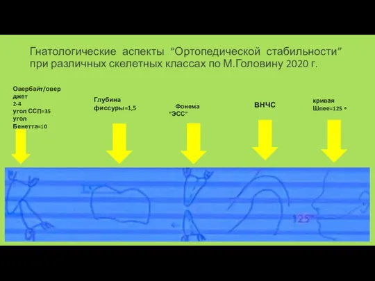 Гнатологические аспекты “Ортопедической стабильности” при различных скелетных классах по М.Головину 2020