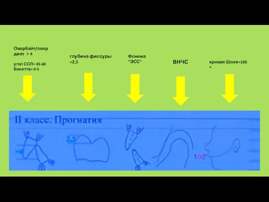 Овербайт/оверджет ﹥4 угол ССП= 45-60 Бенетта= 0-5 глубина фиссуры =2,5 Фонема “ЭСС” ВНЧС кривая Шпее=100 ∘