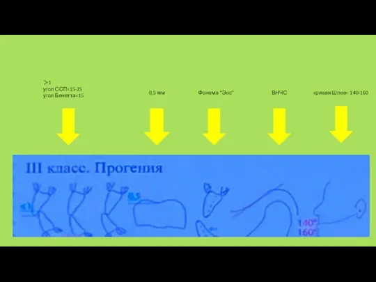 ＞1 угол ССП=15-25 угол Бенетта=15 0,5 мм Фонема “Эсс” ВНЧС кривая Шпее= 140-160