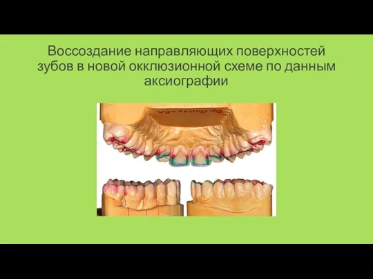 Воссоздание направляющих поверхностей зубов в новой окклюзионной схеме по данным аксиографии