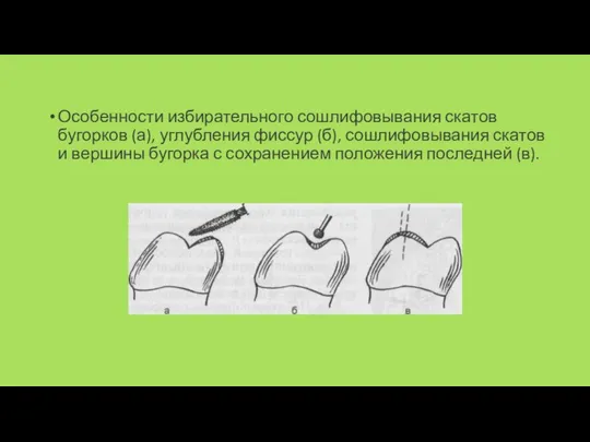 Особенности избирательного сошлифовывания скатов бугорков (а), углубления фиссур (б), сошлифовывания скатов