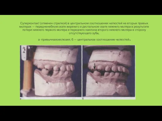Суперконтакт (отмечен стрелкой) в центральном соотношении челю­стей на вторых правых молярах