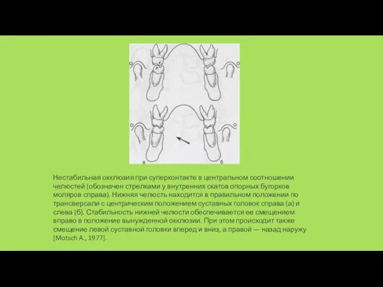 Нестабильная окклюзия при суперконтакте в центральном соотношении челюстей (обозначен стрелками у