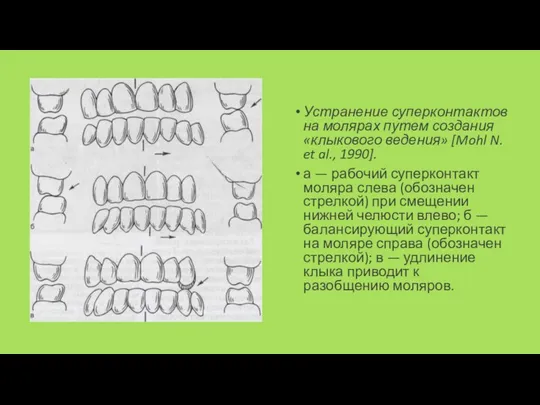 Устранение суперконтактов на молярах путем создания «клыкового ведения» [Mohl N. et