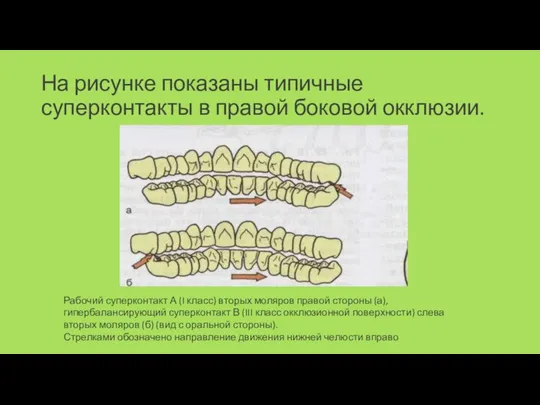 На рисунке показаны типичные суперконтакты в правой боковой окклюзии. Рабочий суперконтакт