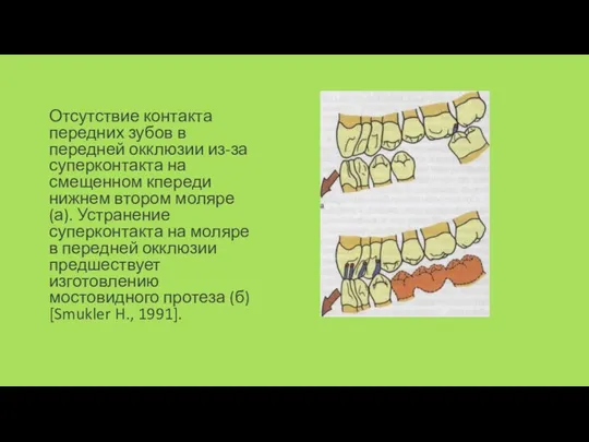 Отсутствие контакта передних зубов в передней окклюзии из-за суперконтакта на смещенном