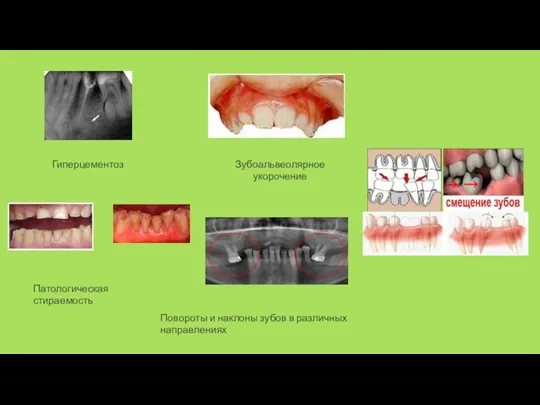 Гиперцементоз Зубоальвеолярное укорочение Повороты и наклоны зубов в различных направлениях Патологическая стираемость