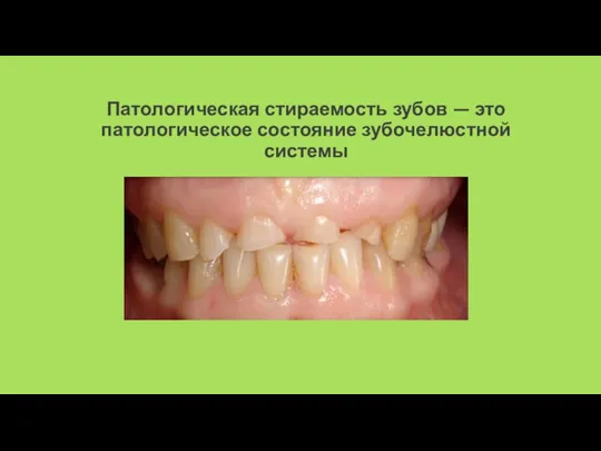 Патологическая стираемость зубов — это патологическое состояние зубочелюстной системы