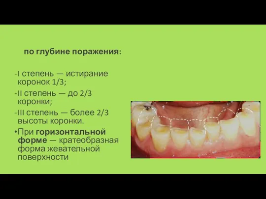 по глубине поражения: I степень — истирание коронок 1/3; II степень