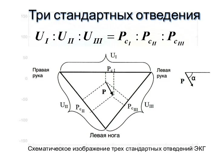 Три стандартных отведения Схематическое изображение трех стандартных отведений ЭКГ