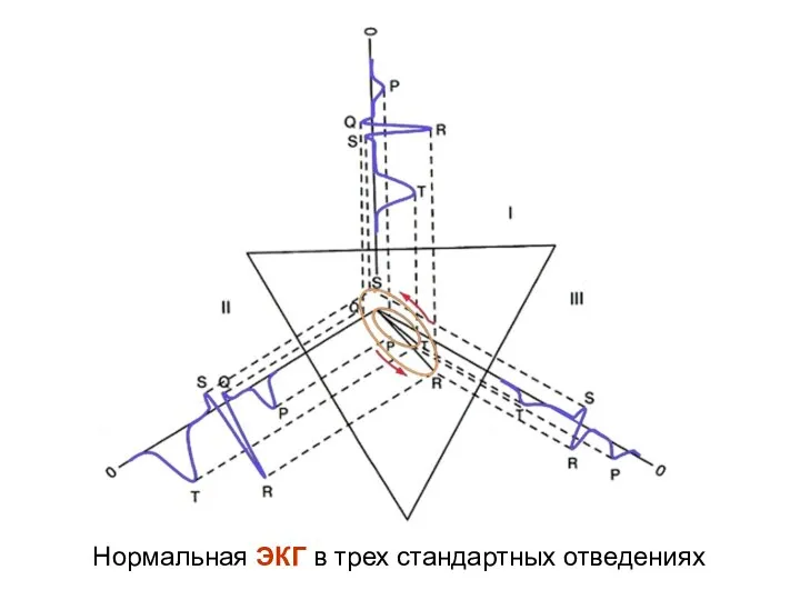 Нормальная ЭКГ в трех стандартных отведениях