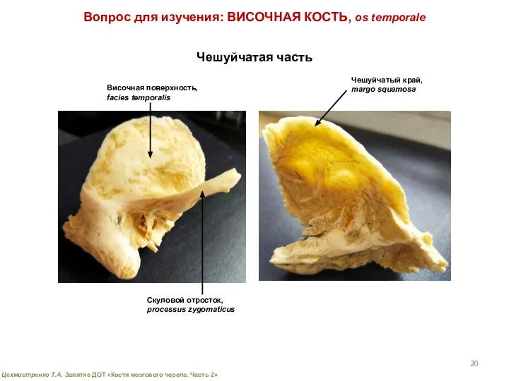 Вопрос для изучения: ВИСОЧНАЯ КОСТЬ, os temporale Чешуйчатая часть Височная поверхность,