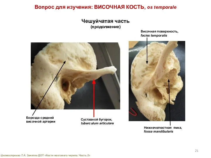 Вопрос для изучения: ВИСОЧНАЯ КОСТЬ, os temporale Чешуйчатая часть (продолжение) Суставной