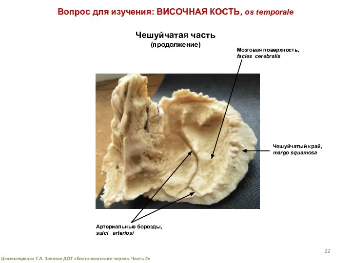 Вопрос для изучения: ВИСОЧНАЯ КОСТЬ, os temporale Чешуйчатая часть (продолжение) Мозговая