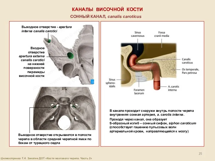 КАНАЛЫ ВИСОЧНОЙ КОСТИ СОННЫЙ КАНАЛ, canalis caroticus Входное отверстие apertura externa