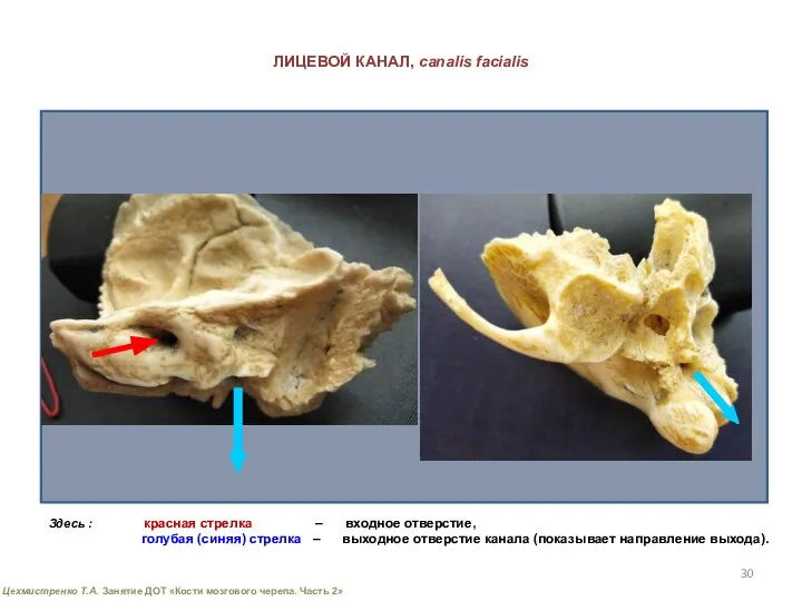 ЛИЦЕВОЙ КАНАЛ, canalis facialis Здесь : красная стрелка – входное отверстие,