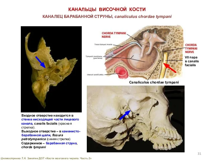 КАНАЛЬЦЫ ВИСОЧНОЙ КОСТИ Canaliculus chordae tympani КАНАЛЕЦ БАРАБАННОЙ СТРУНЫ, canaliсulus chordae