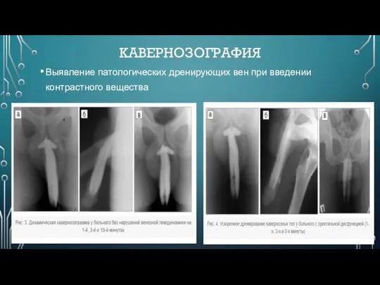 КАВЕРНОЗОГРАФИЯ Выявление патологических дренирующих вен при введении контрастного вещества