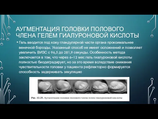 АУГМЕНТАЦИЯ ГОЛОВКИ ПОЛОВОГО ЧЛЕНА ГЕЛЕМ ГИАЛУРОНОВОЙ КИСЛОТЫ Гель вводится под кожу