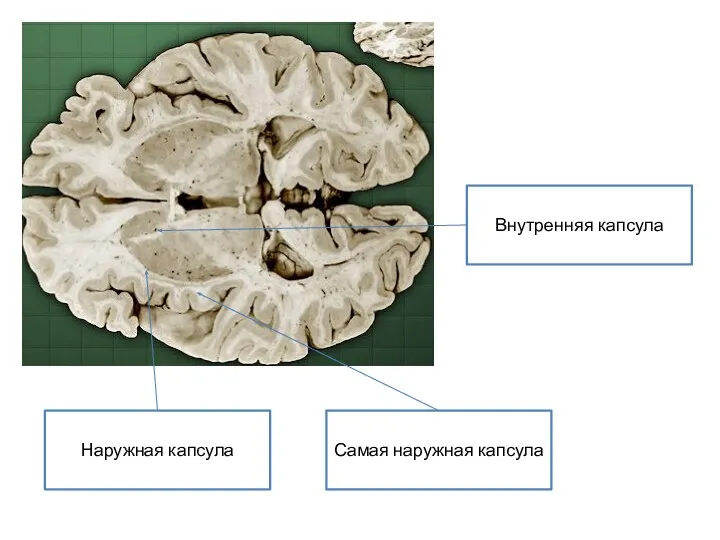 Наружная капсула Самая наружная капсула Внутренняя капсула