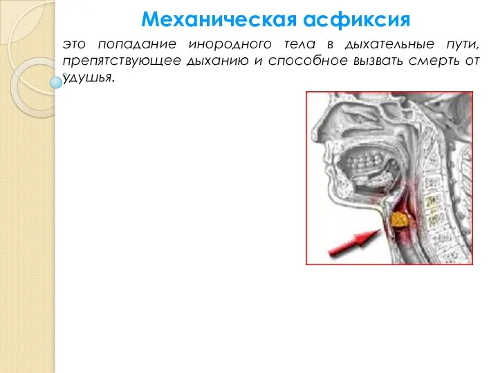 Механическая асфиксия это попадание инородного тела в дыхательные пути, препятствующее дыханию