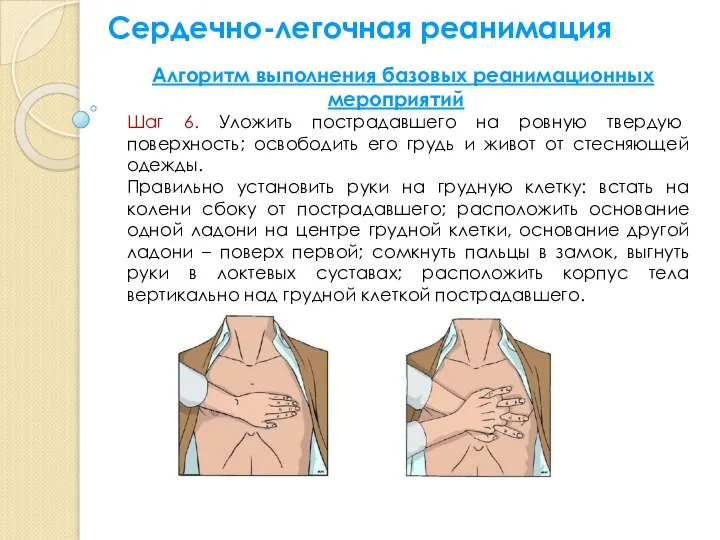 Сердечно-легочная реанимация Алгоритм выполнения базовых реанимационных мероприятий Шаг 6. Уложить пострадавшего