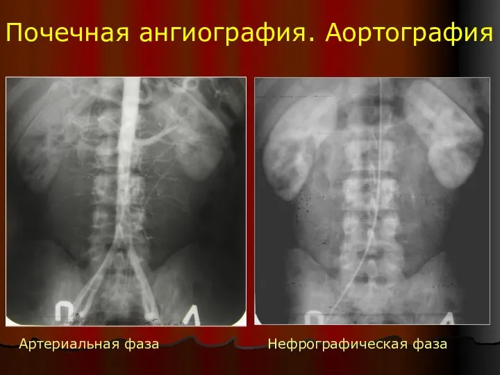 Почечная ангиография. Аортография Артериальная фаза Нефрографическая фаза