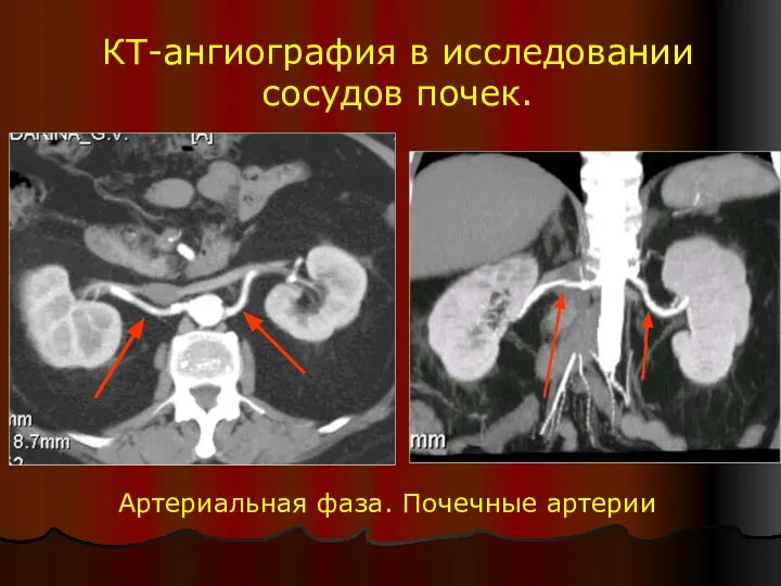 КТ-ангиография в исследовании сосудов почек. Артериальная фаза. Почечные артерии