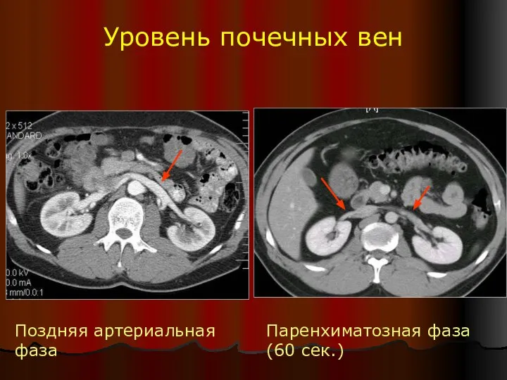 Уровень почечных вен Поздняя артериальная фаза Паренхиматозная фаза (60 сек.)